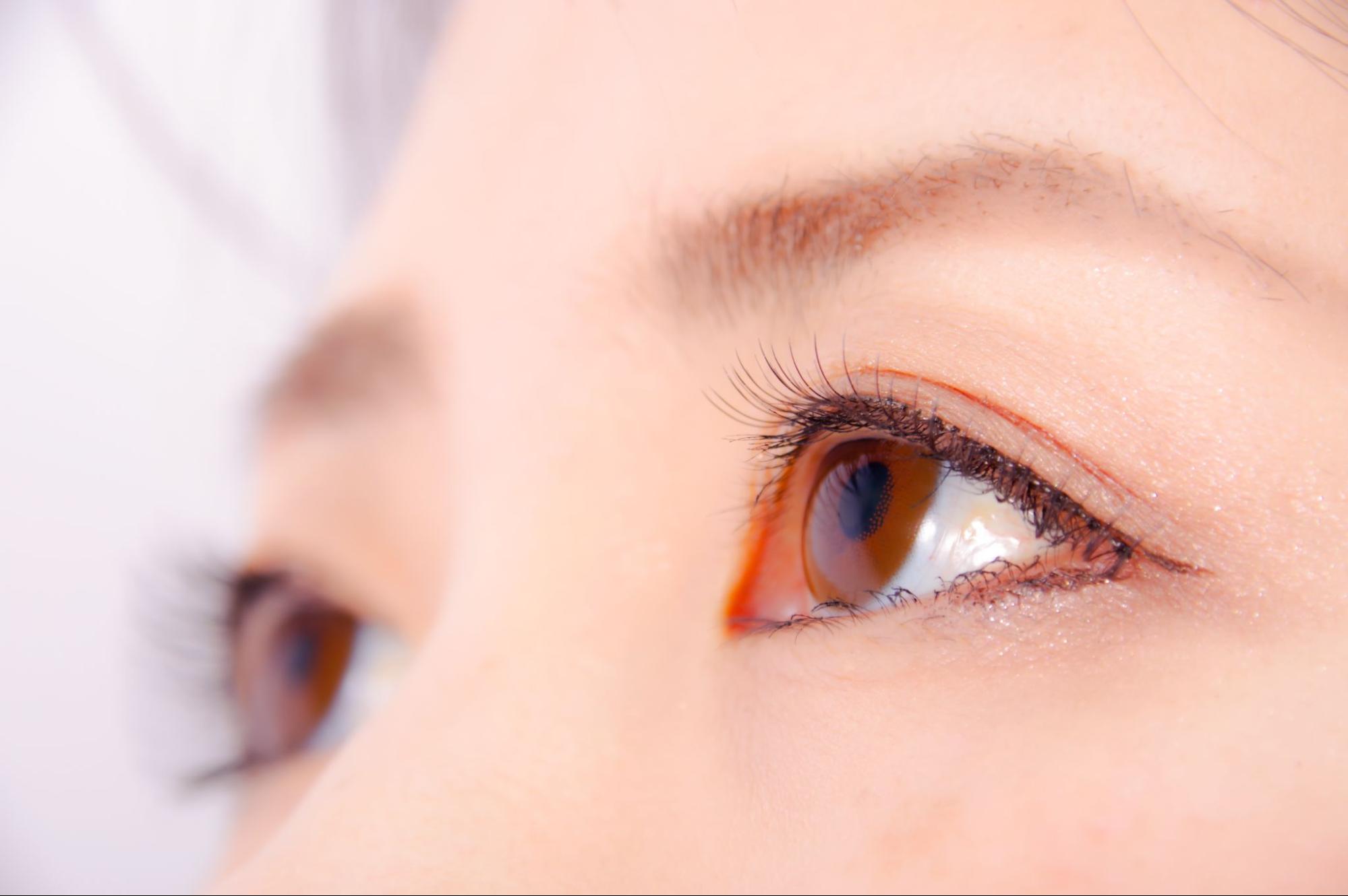 眼瞼下垂が片目だけに起こりやすい人の特徴