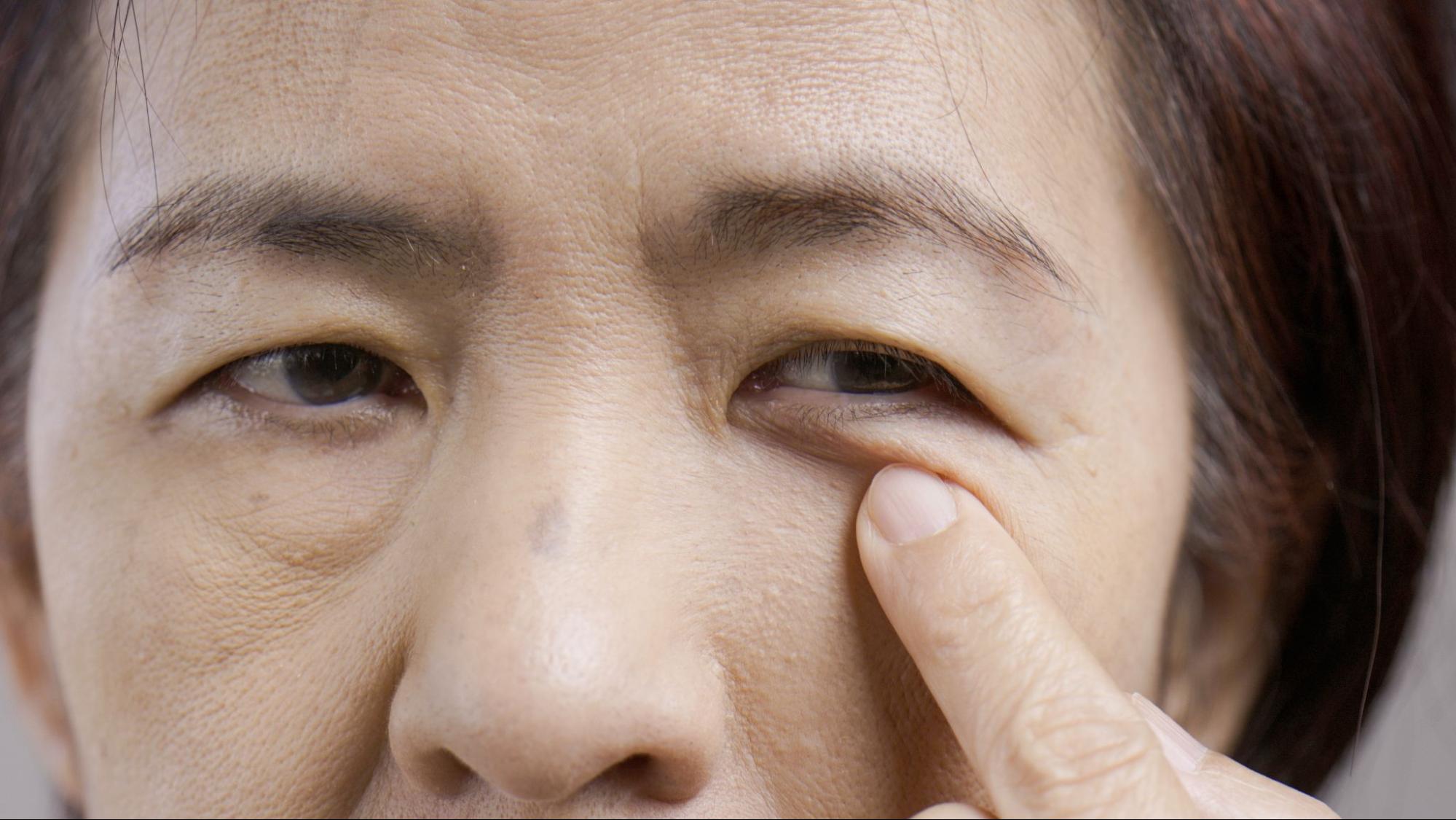 突然片目だけが眼瞼下垂になる原因は病気の可能性も