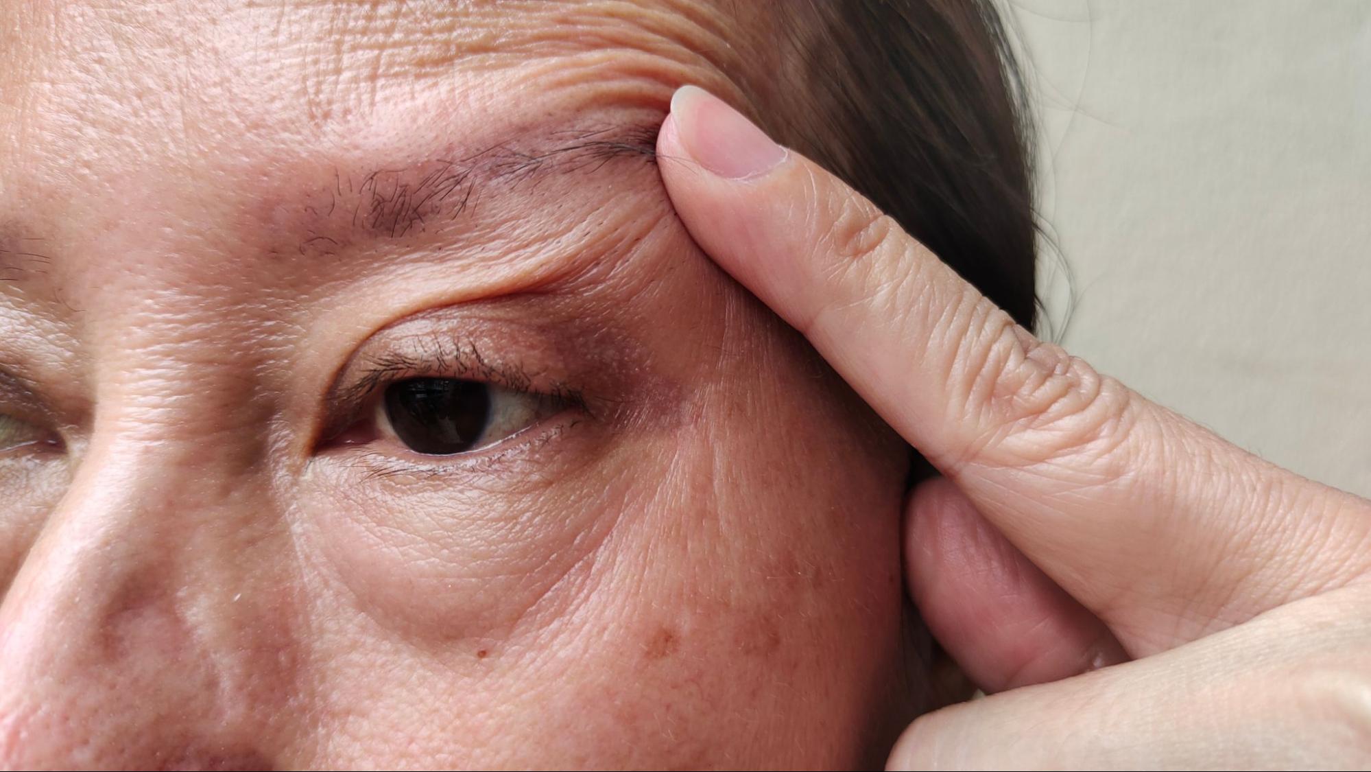片目だけ眼瞼下垂を手術することも可能