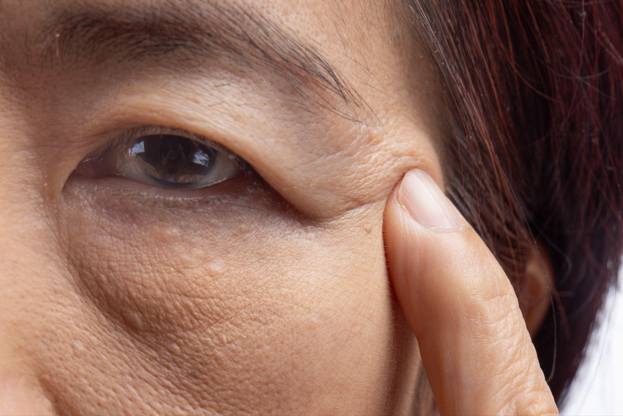 眼瞼下垂の原因は？なりやすい人の特徴やセルフチェック方法を解説