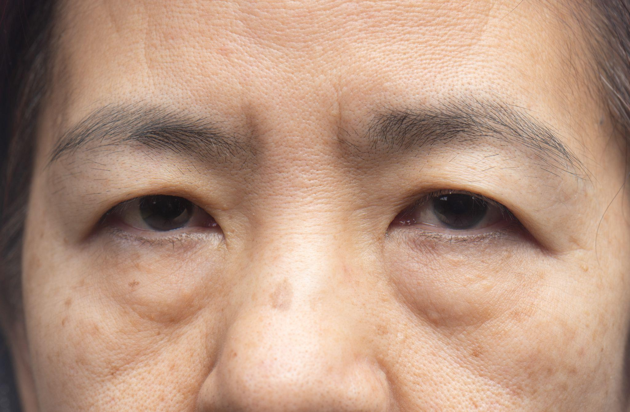 眼瞼下垂の症状